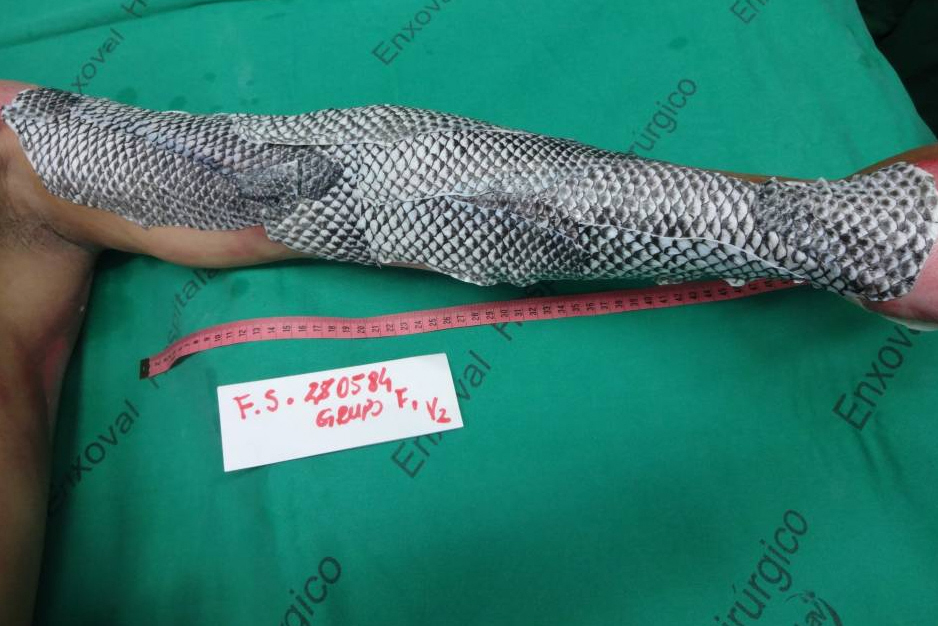 পোড়া সারিয়ে তোলার প্রাকৃতিক নিরাময় পদ্ধতি কি?