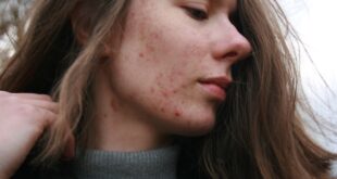 ব্রণ কি?