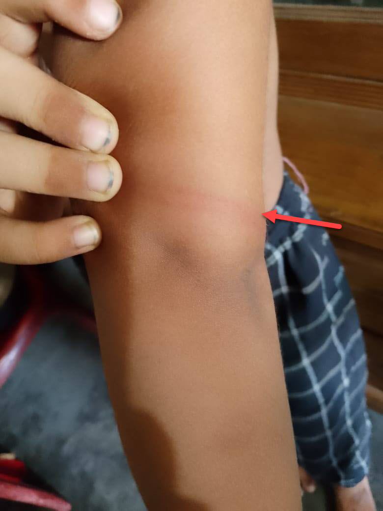 ৮ বছরের শিশু মাদ্রাসায় হুজুরের কাছে নিরযাতিত হবার প্রায় দু সপ্তাহ পরের ফটো