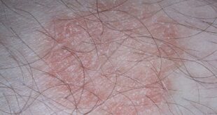 দাদের চিকিৎসা