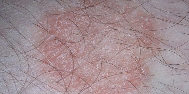 দাদের চিকিৎসা